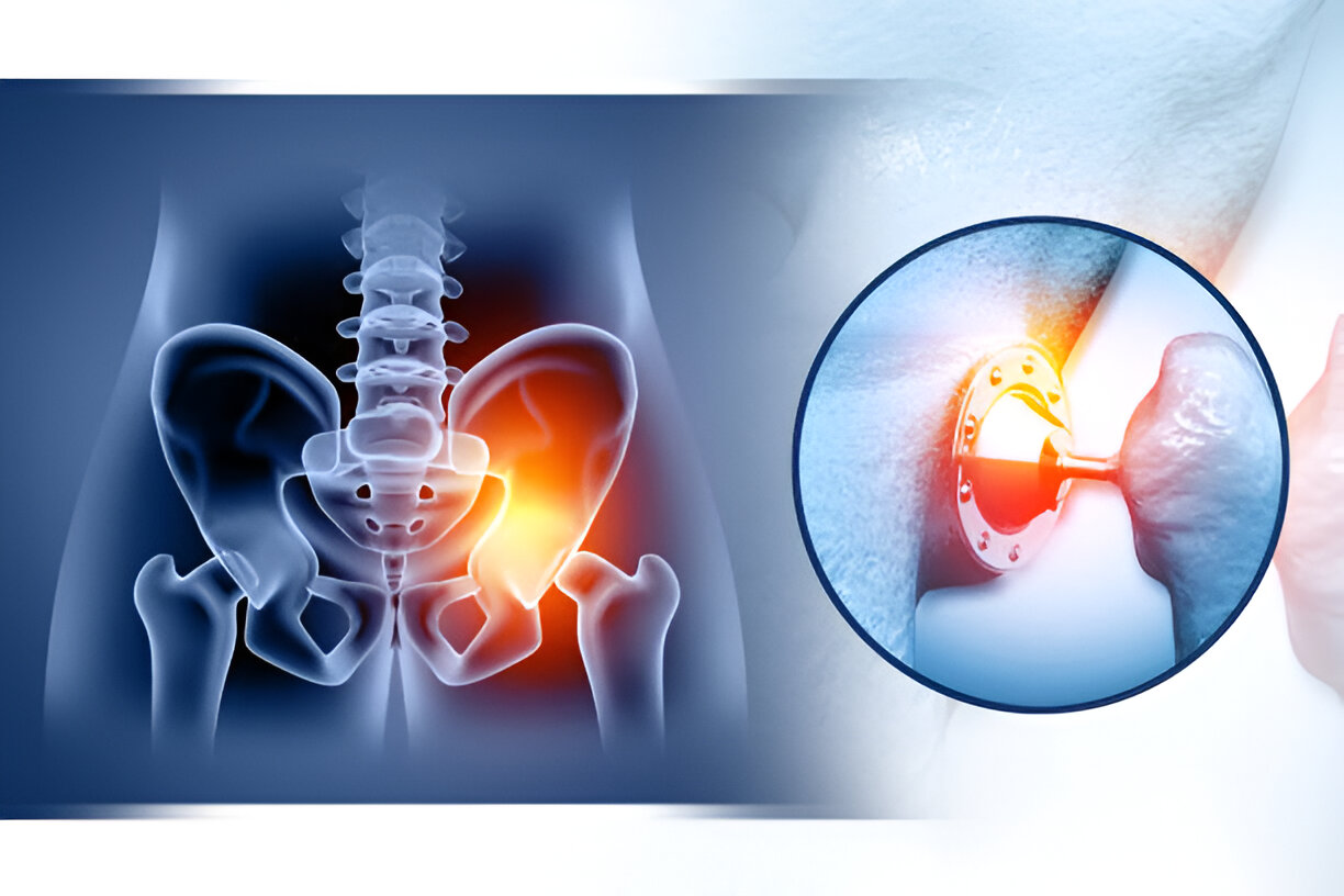 Hip Replacement