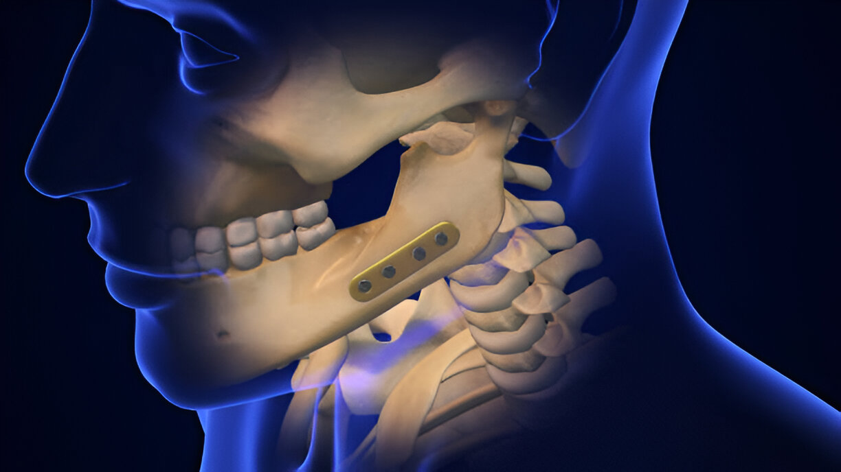 Cervical Lateral Mass Fixation
