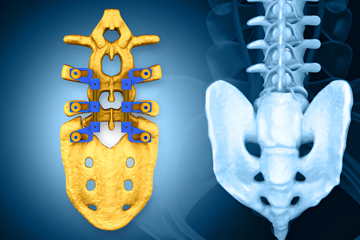 MISTLIF (Minimally Invasive Transforaminal Lumbar Interbody Fusion)
