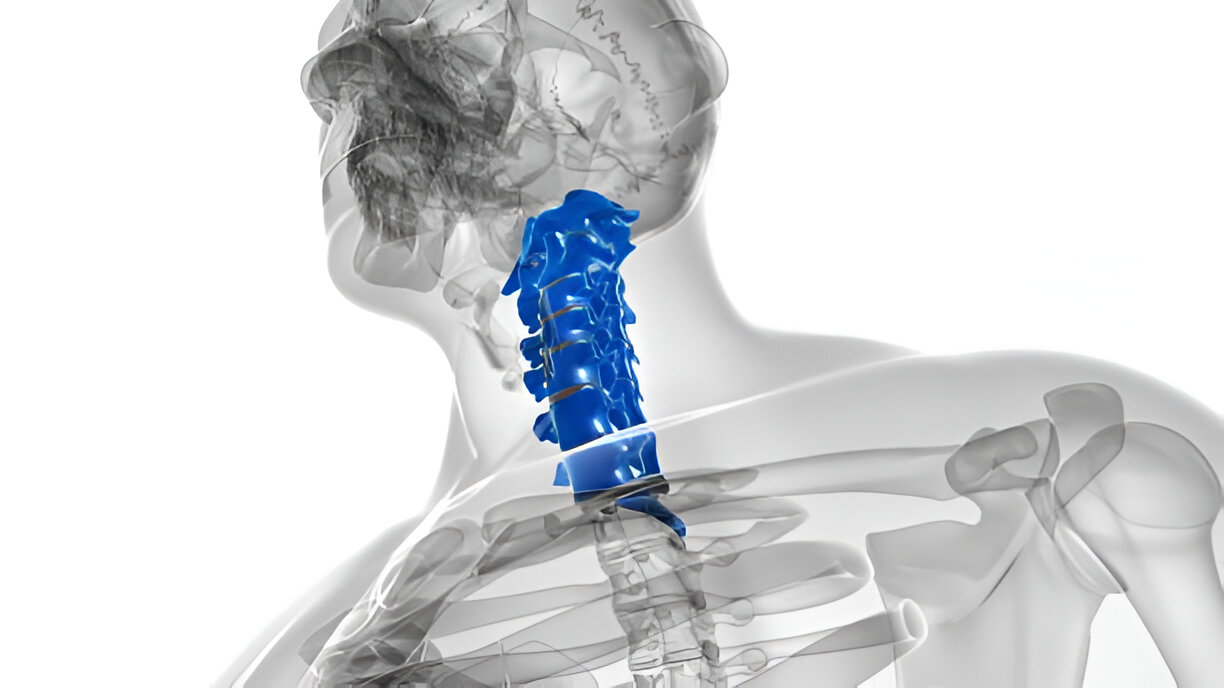 Cervical Fusion Surgeries